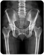 Hip X-ray, AP view