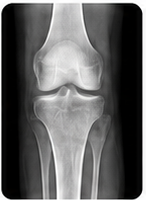 Knee X-ray, AP view