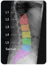 Lumbar X-ray, lateral view, with colour-segmented vertebrae